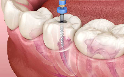 Root Canal Treatment