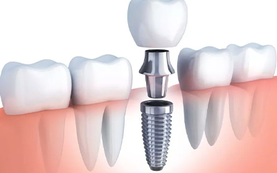 Dental Implants