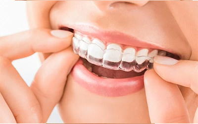 Invisible Braces (Clear Aligners)