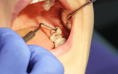 Wisdom Tooth Extraction